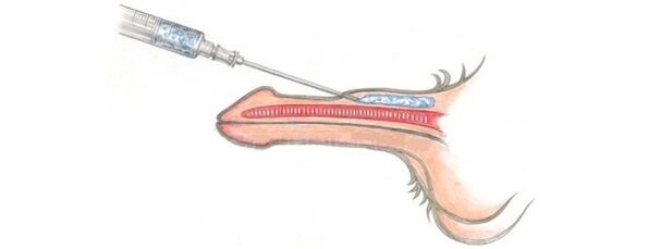 Lipofilling, which makes it possible to increase the size of the phallus
